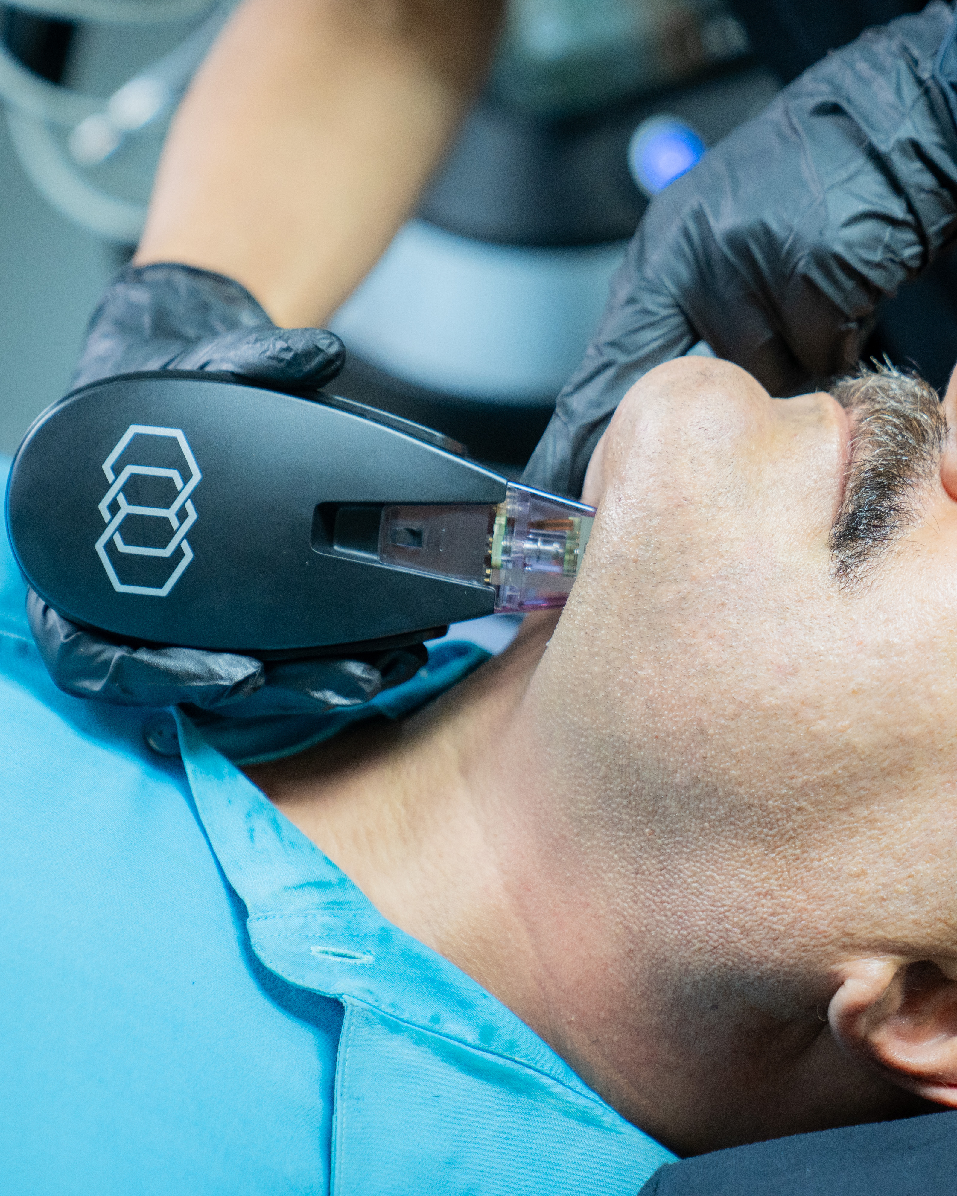 Morpheus8 Burst RF Microneedling treatment