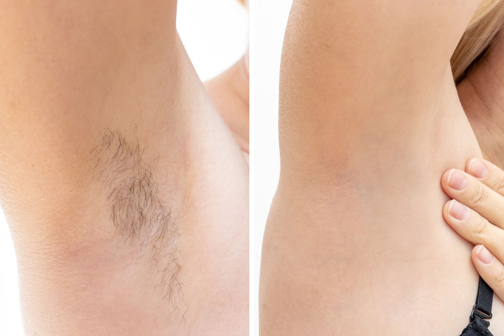 IPL Hair Removal in Valrico, FL